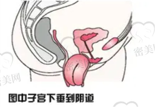 产后如何判断出现子宫下垂的问题