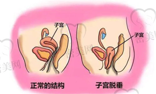 有这下垂问题的话在月子里边能咋补救