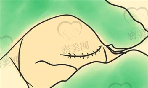 剖产后生第二个娃剖腹产比较放心