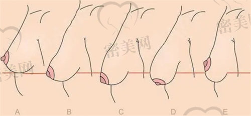 乳房下垂程度