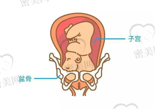 骨盆宽了的话能自然修正不