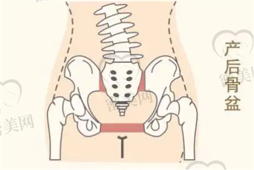 为什么医院不建议做骨盆修复