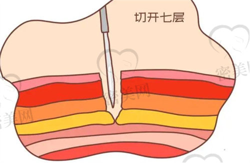 剖腹产切开七层