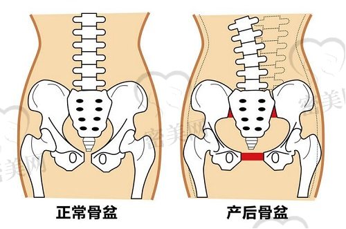 正常骨盆vs产后骨盆