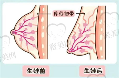 哺乳后乳房干瘪下垂还能不能恢复？