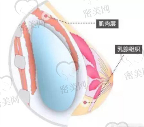 成都华美紫馨整形双平面隆胸