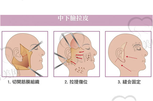 谭永嘉医生做拉皮技术怎么样