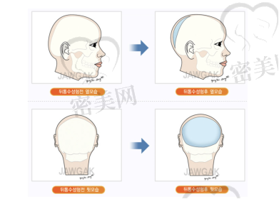 雕刻整形外科#骨水泥填充术#