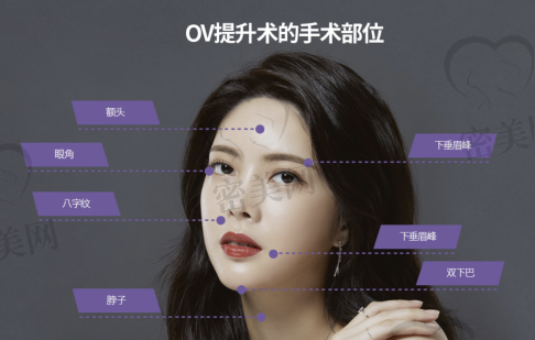 欧佩拉整形外科#OV提升术 