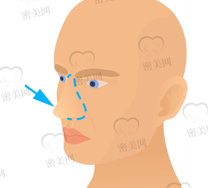 成都鼻整形医院排名前十