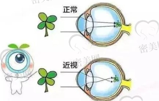 虹膜睫状体炎会发展成青光眼吗