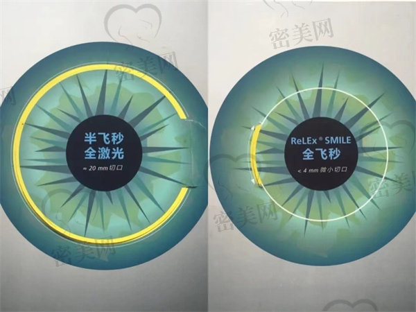 做全飞秒激光手术后视力可以维持多久