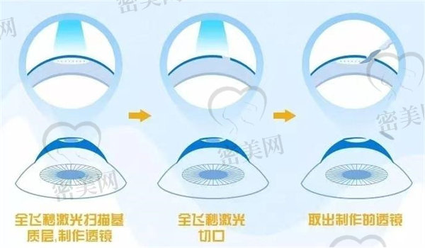 多样手术方式满足考生的需求