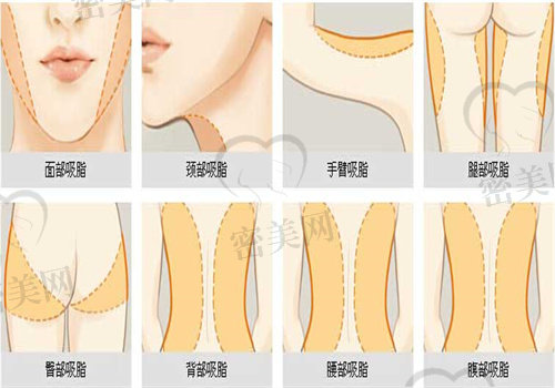 吸脂手术后能管几年？
