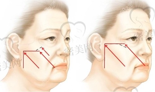 磨骨手术价格表