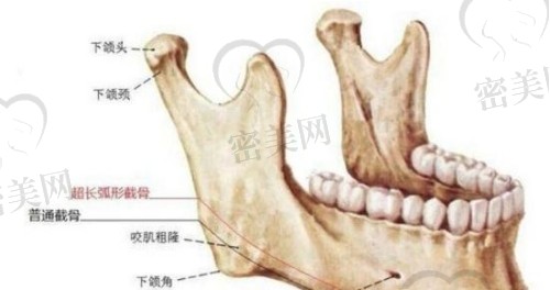 磨骨和截骨区别