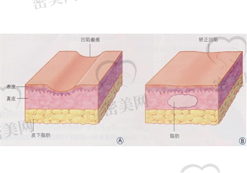 面部脂肪填充一个月后还会吸收吗