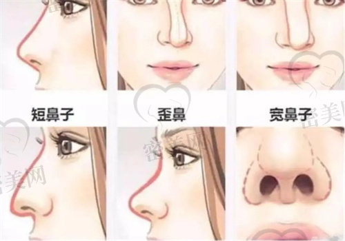 杭州美莱做鼻子技术水平高