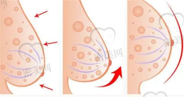 乳房下垂上提手术怎么做