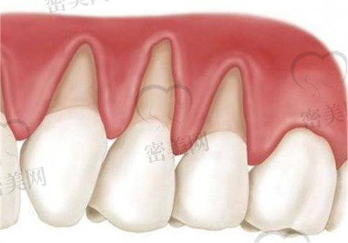 牙龈萎缩牙齿松动怎么恢复