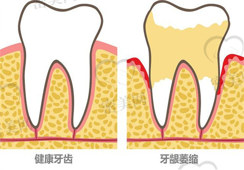 牙龈萎缩牙齿松动怎么恢复