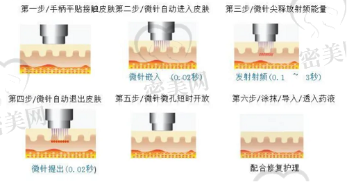 黄金微针和光子嫩肤哪个祛痘印好