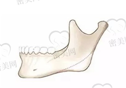 下颌角削骨和磨骨的区别