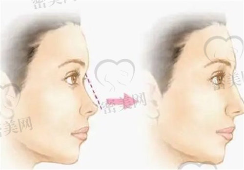 玻尿酸隆鼻和自体脂肪隆鼻的区别