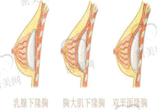 曼托精致版什么时候变软