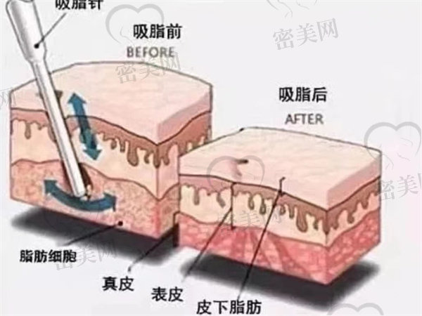 什么叫水动力吸脂