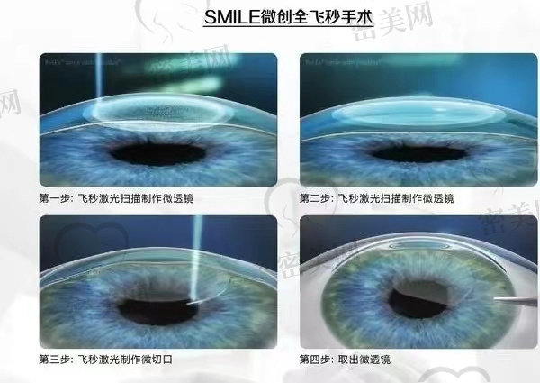 炎热的夏季能否进行近视手术