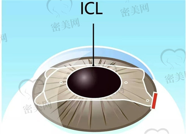 icl晶体植入手术