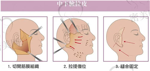 面部紧致提升的医美项目