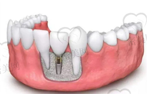 种植牙的好处