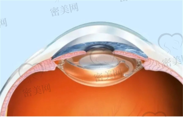 晶体植入和全飞秒激光手术哪个好
