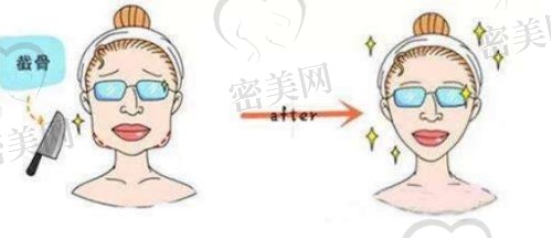 颧骨内推两年后脸必定会下垂吗