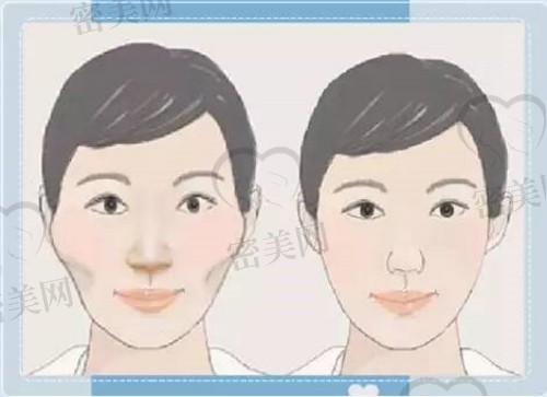 颧骨内推两年后脸下垂的原因