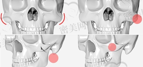 做颧骨内推手术如何避免皮肤下垂？