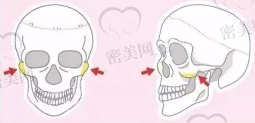 颧骨内推两年后脸必定会下垂吗