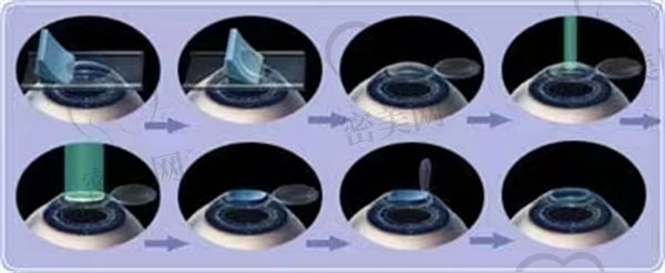 精diao微飞秒激光近视手术有哪些特点