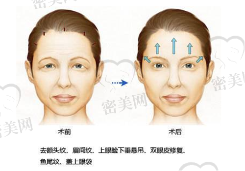 内窥镜额部除皱术能解决哪些问题