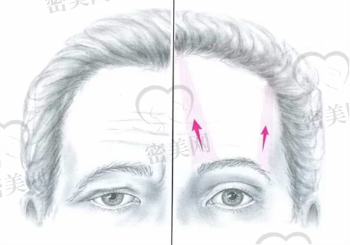 内窥镜额部除皱术能解决哪些问题