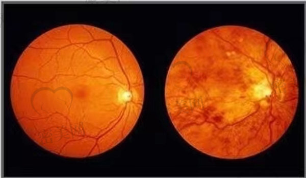 视网膜出现萎缩