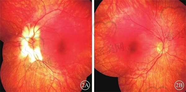 视网膜萎缩哪一种治疗方法比较好