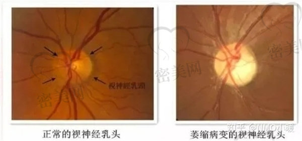 视网膜复位手术