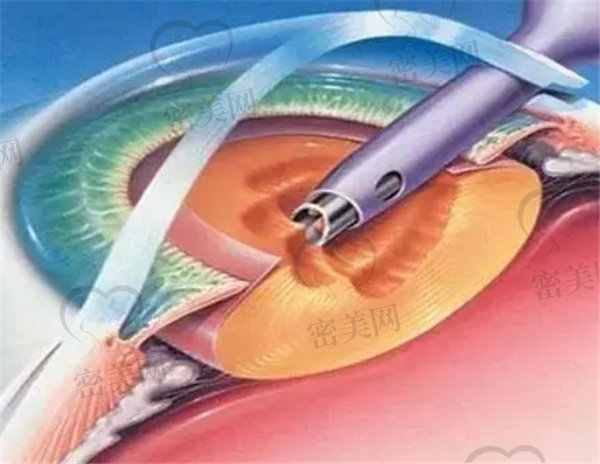 飞秒辅助白内障手术有何优缺点