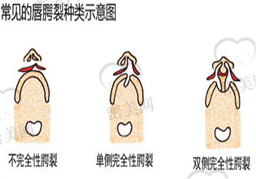 1度轻微唇裂需要手术吗