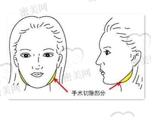 籍建华磨骨到底怎么样？