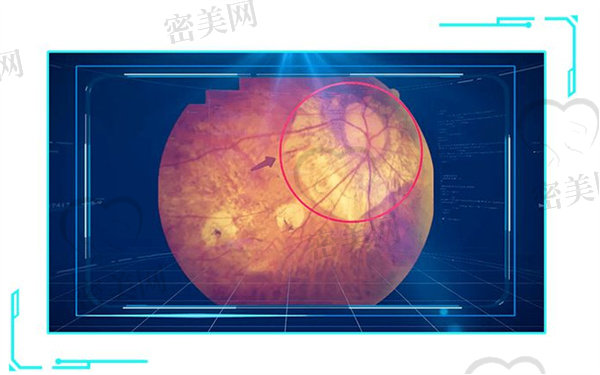 人工视网膜植入可以治疗失明吗