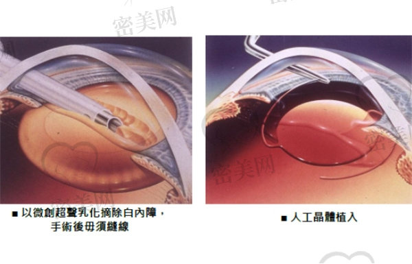 白内障手术晶体怎么选择